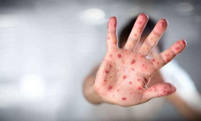 Com 41 mil casos, Europa registra recorde de infectados com sarampo